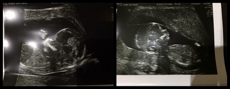 Meine Zwillingsschwangerschaft – Ein kurzer Einblick